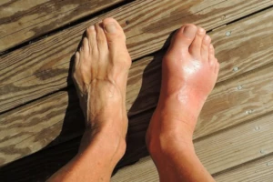 Aufgrund von Harnsäure-Kristallen können bei Gicht Zehen und Füße anschwellen